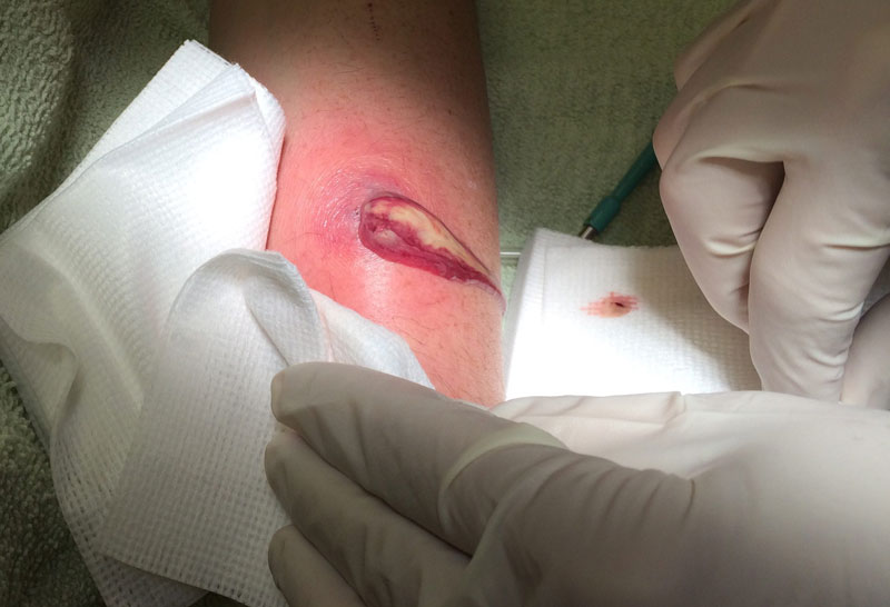 Rạch áp xe – cắt u – lấy dị vật